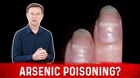 Strong medication The use of strong drugs or medication may have a side effect of white spots on fingernails. . Signs of poisoning in fingernails